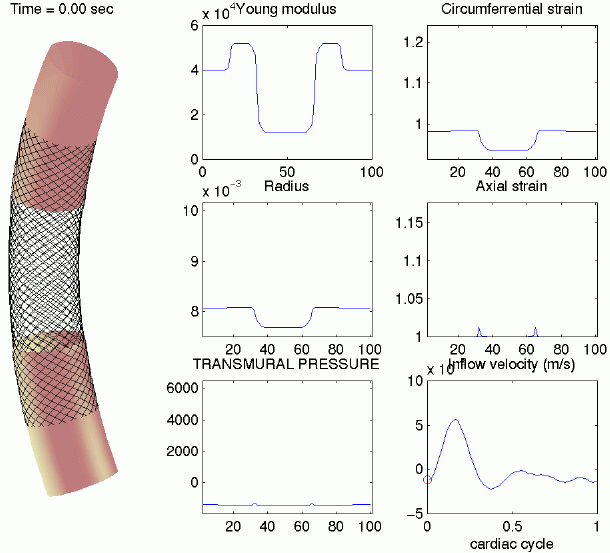 3 full-length overlapping stents in a curved vessel